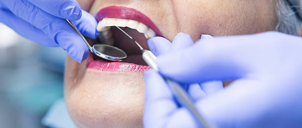 Best Chipped Tooth Repair Near Me  in Mount Sterling, OH